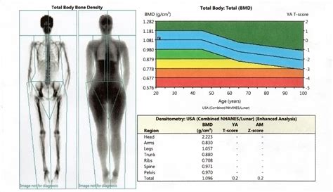 Bone Mineral Density Scan (DEXA) .